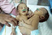 Влошава се състоянието на сиамските близнаци от Сливен