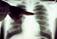 Безплатни прегледи за туберкулоза в сливенската болница  